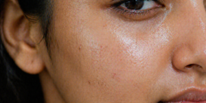 oily skin