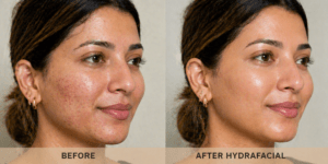 hydrafacial